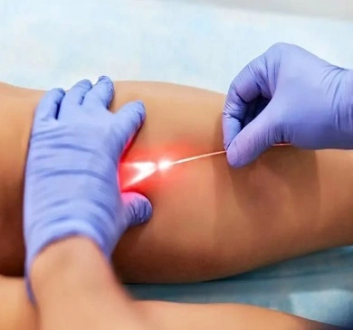 laser-vericose-vein-treatment-in-dindigul
